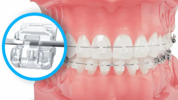 Chỉnh nha mắc cài sứ