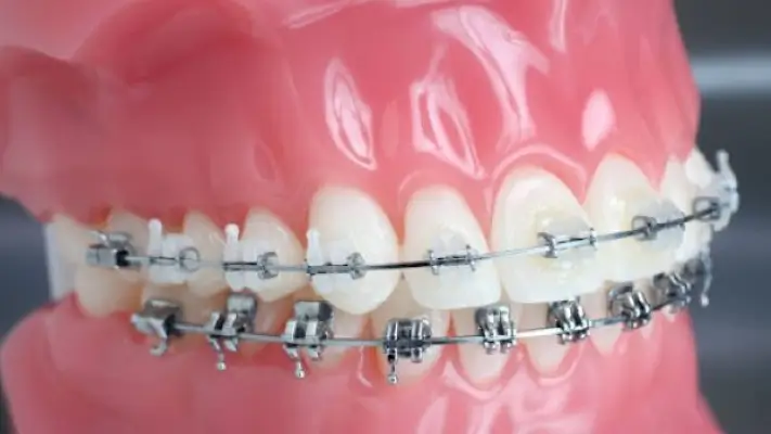 Chỉnh nha mắc cài tự buộc