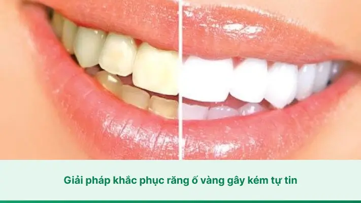 Giải pháp khắc phục răng ố vàng gây kém tự tin