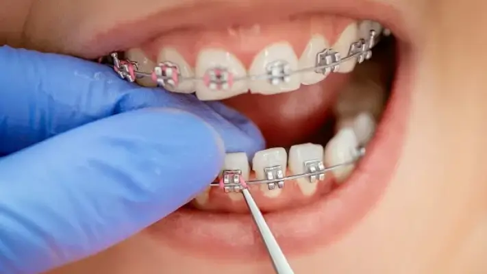 Niềng răng mắc cài kim loại