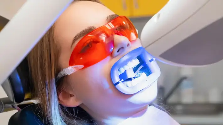 Tẩy trắng răng tại ghế