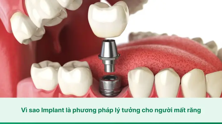 Vì sao cấy ghép Implant là phương pháp lý tưởng cho người mất răng