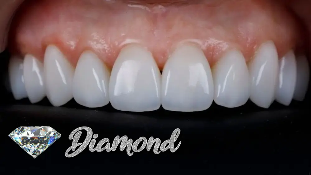 Răng toàn sứ Vita Diamond