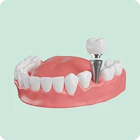 trong rang implant