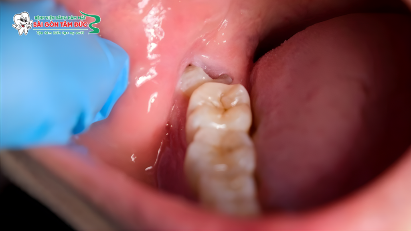 Biến chứng răng khôn mọc lệch