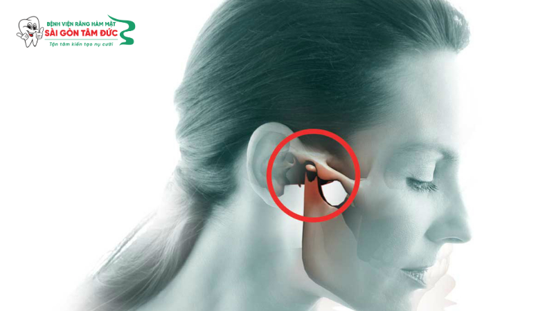 Viêm khớp thái dương hàm (TMJ)