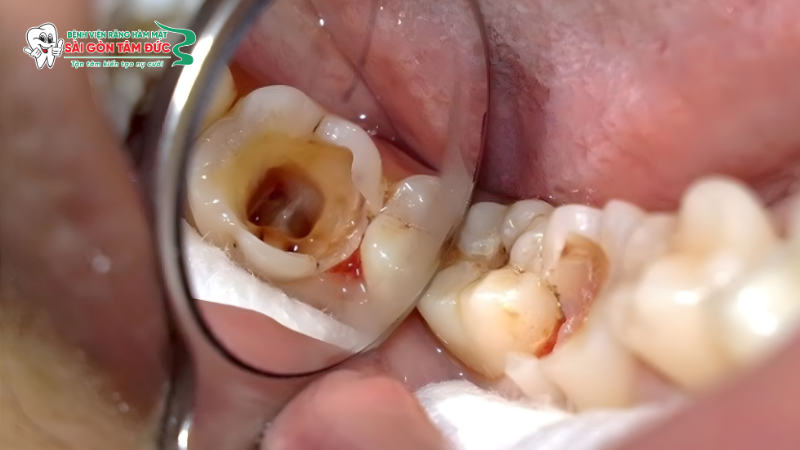 Hoại tử tủy răng