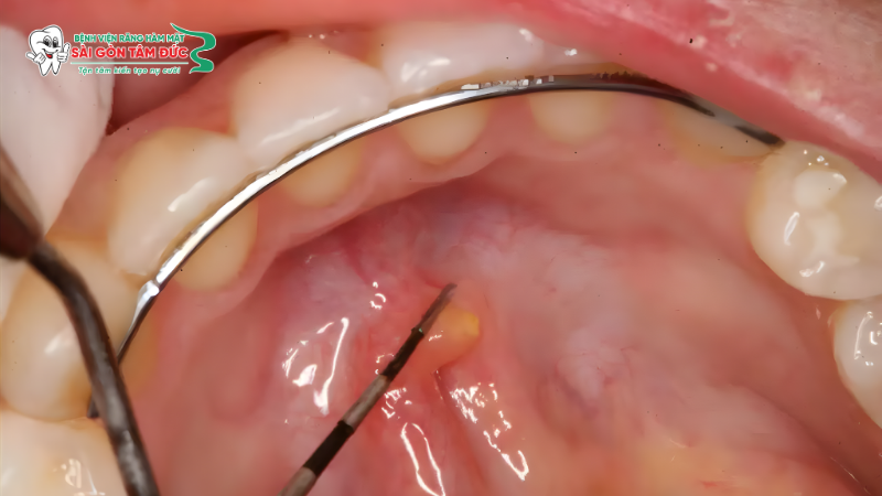 Vôi hóa tuyến nước bọt (Sỏi tuyến nước bọt)