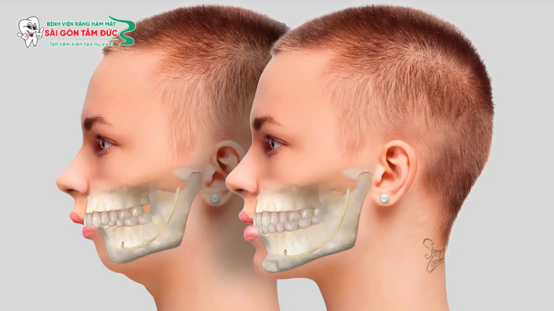 Tìm hiểu phẫu thuật hàm hô là gì?