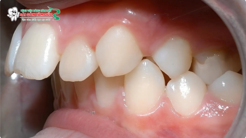 Hệ lụy nếu không điều trị kịp thời