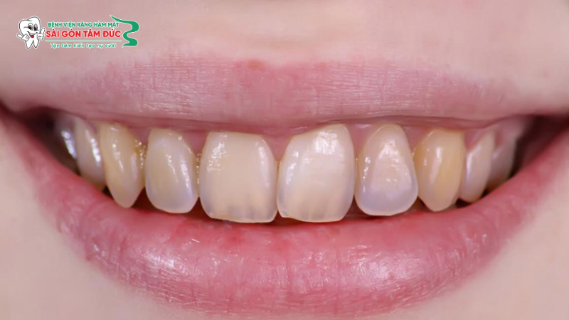 Dấu hiệu nhận biết răng đang dần mất đi độ sáng bóng