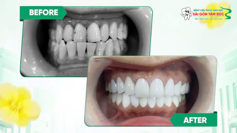 Phương pháp tẩy trắng răng chuyên nghiệp
