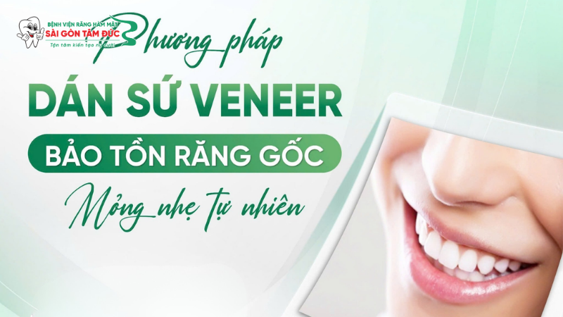 Dán sứ Veneer thẩm mỹ