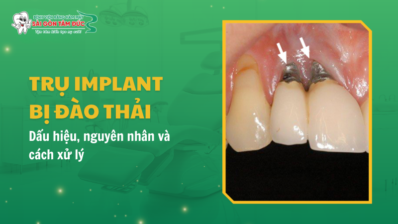 Trụ Implant bị đào thải: Dấu hiệu, nguyên nhân và cách xử lý an toàn