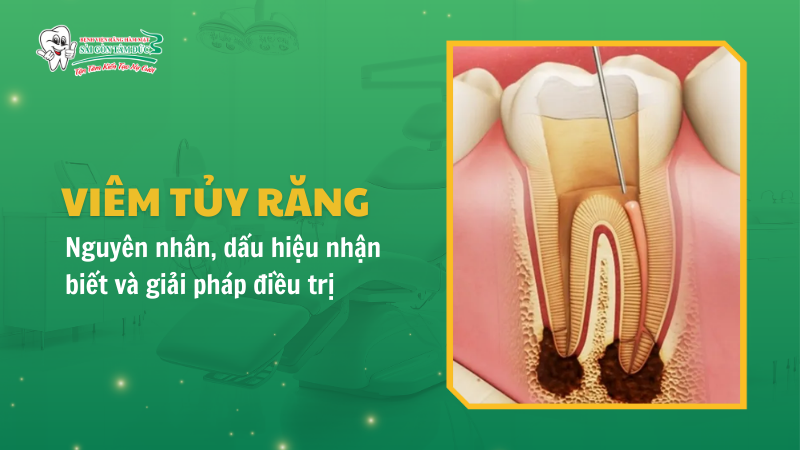 Viêm tủy răng: Nguyên nhân, dấu hiệu nhận biết và giải pháp điều trị triệt để
