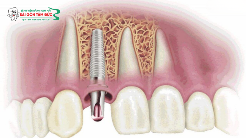 Trụ Implant bị đào thải là gì?