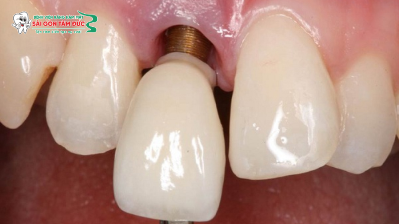 Trụ Implant bị lung lay, xô lệch