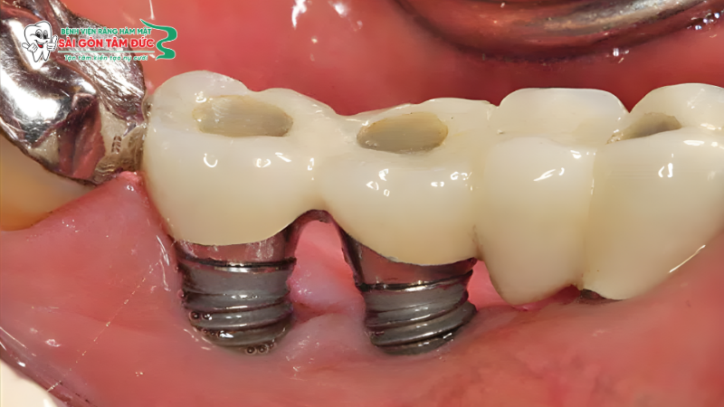 Trụ Implant bị trồi lên hoặc lộ thân trụ