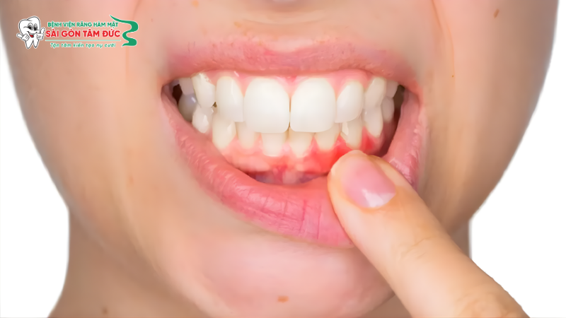 Thay đổi về màu sắc và hình thái lợi