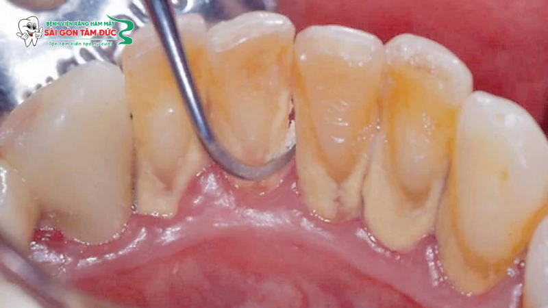 Thủ phạm chính từ mảng bám và vôi răng