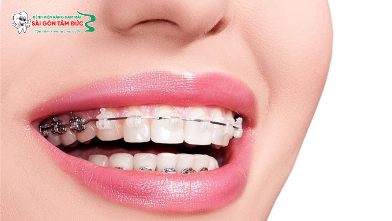 Bọc răng sứ có niềng răng được không? Giải đáp chi tiết từ chuyên gia 2 boc rang su co nieng rang duoc khong 2