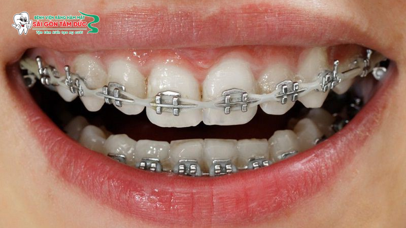 Bọc răng sứ có niềng răng được không? Giải đáp chi tiết từ chuyên gia 5 boc rang su co nieng rang duoc khong 6