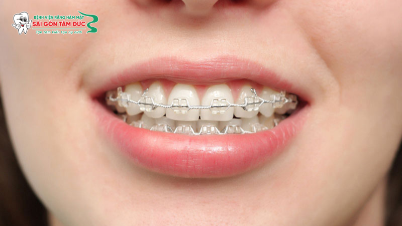 Lưu ý trước khi niềng răng: Cẩm nang toàn diện từ A-Z 2 luu y truoc khi nieng rang 2