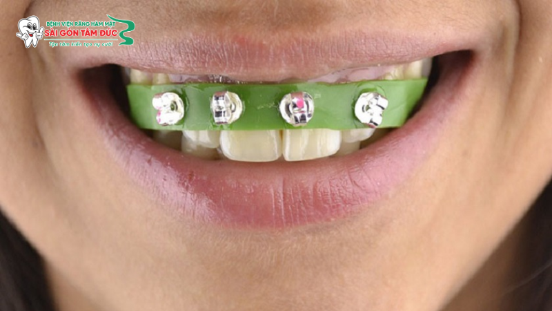 nieng rang tai nha 2