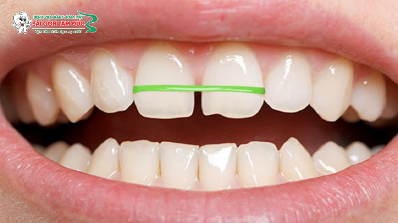 nieng rang tai nha 5