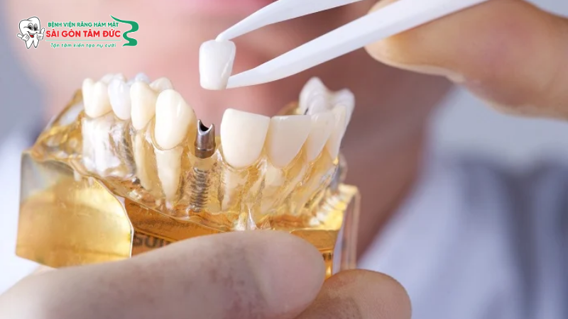 Trồng răng Implant có đau không? Giải đáp từ chuyên gia 2 trong rang implant co dau khong 2