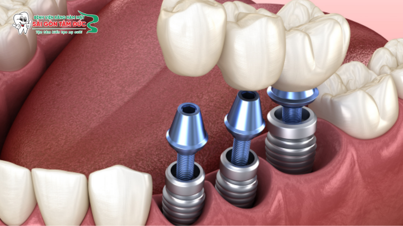 Trồng răng Implant mất bao lâu? Cập nhật thời gian và quy trình chi tiết 2 trong rang implant mat bao lau 2