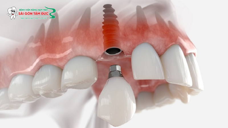 Trồng răng Implant mất bao lâu? Cập nhật thời gian và quy trình chi tiết 4 trong rang implant mat bao lau 4