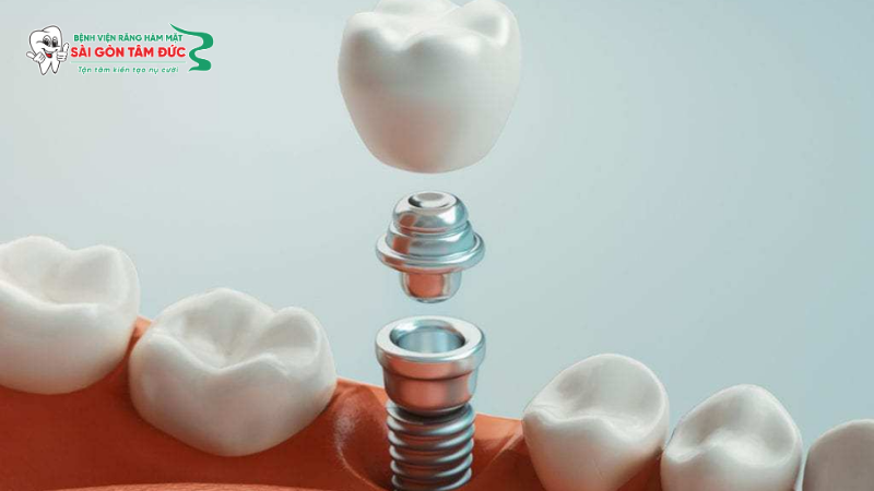 Trồng răng Implant mất bao lâu? Cập nhật thời gian và quy trình chi tiết 5 trong rang implant mat bao lau 5