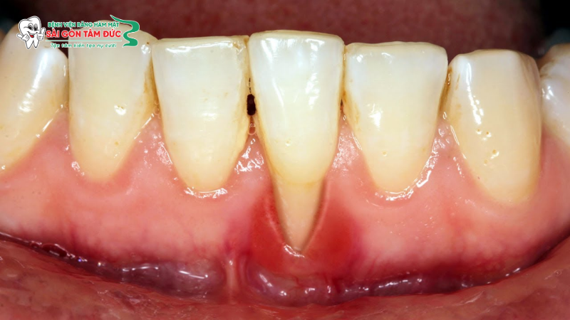 Bị tụt lợi khi niềng răng: Dấu hiệu, Nguyên nhân và cách xử lý dứt điểm 2 tut loi khi nieng rang 2