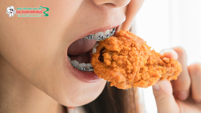 Bị tụt lợi khi niềng răng: Dấu hiệu, Nguyên nhân và cách xử lý dứt điểm 4 tut loi khi nieng rang 4