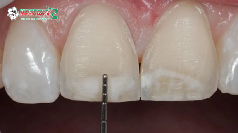 uu nhuoc diem cua boc rang su 5