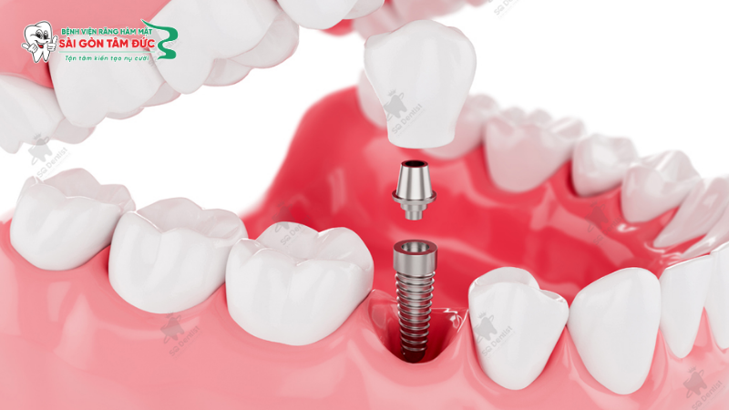 uu nhuoc diem cua trong rang implant 2