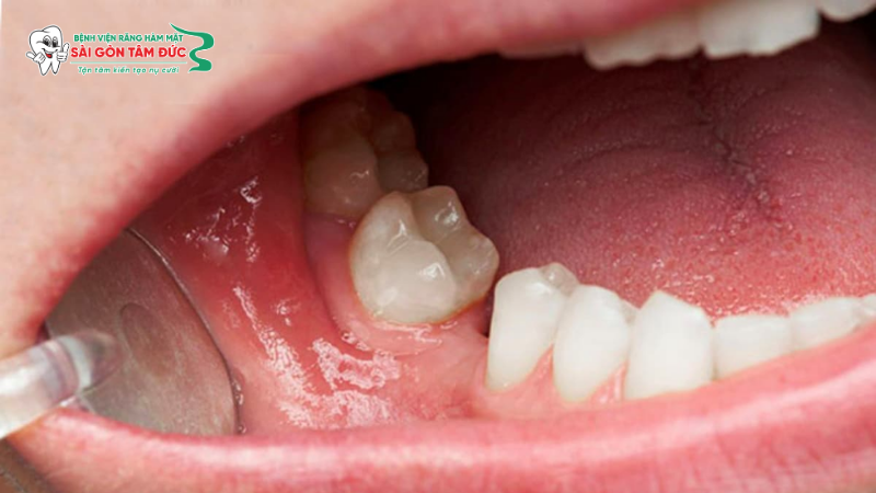 uu nhuoc diem cua trong rang implant 3