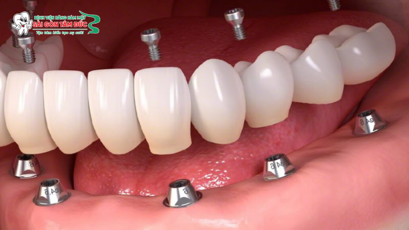 uu nhuoc diem cua trong rang implant 5
