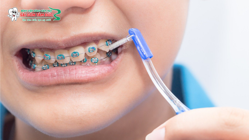 ve sinh rang nieng 3