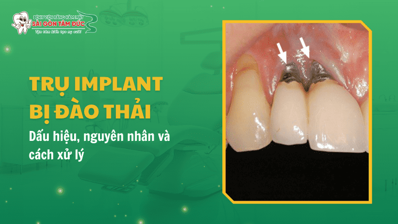 1thumb tru implant bi dao thai benhvienranghammatsaigontamduc