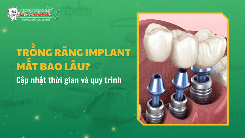 trong rang implant mat bao lau 1